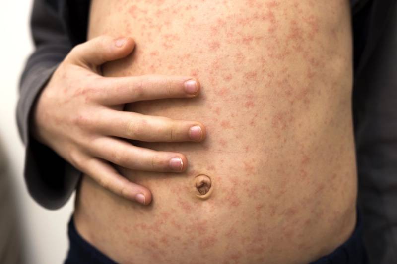 Health officials on alert as measles cases on the rise again in Murcia